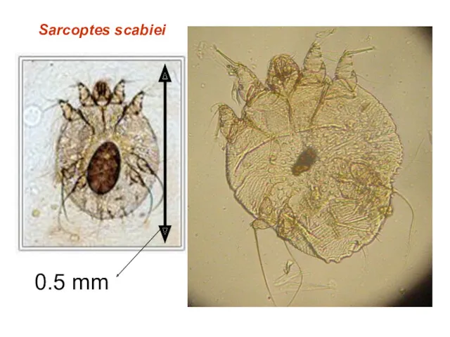 0.5 mm Sarcoptes scabiei