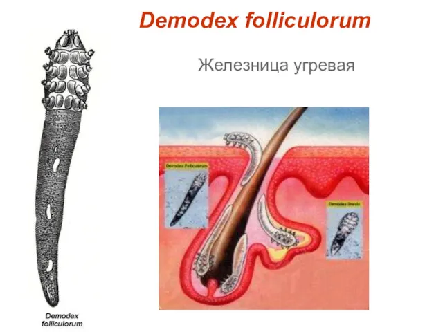 Demodex folliculorum Железница угревая