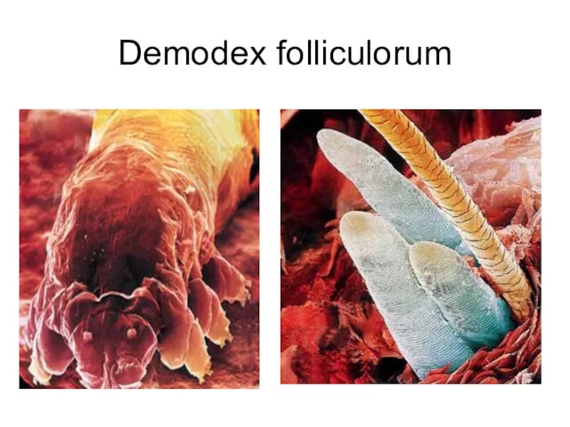 Demodex folliculorum