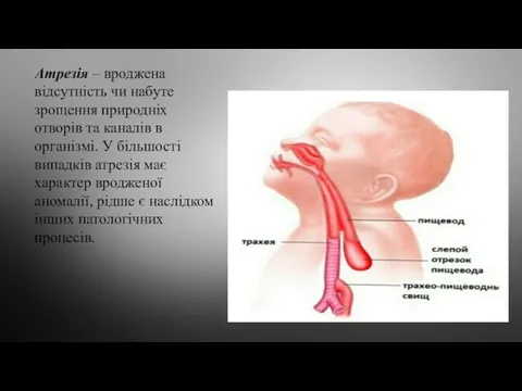 Атрезія – вроджена відсутність чи набуте зрощення природніх отворів та