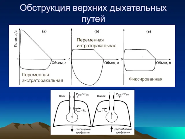 Обструкция верхних дыхательных путей Переменная экстраторакальная Переменная интраторакальная Фиксированная