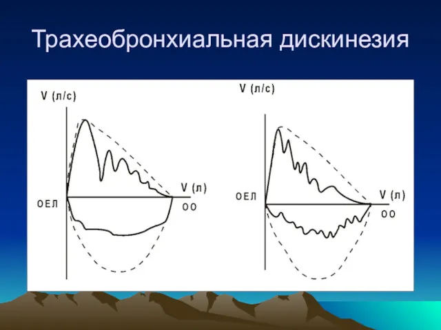 Трахеобронхиальная дискинезия