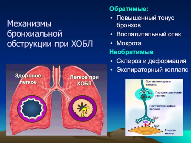 Здоровое легкое Легкое при ХОБЛ Обратимые: Повышенный тонус бронхов Воспалительный