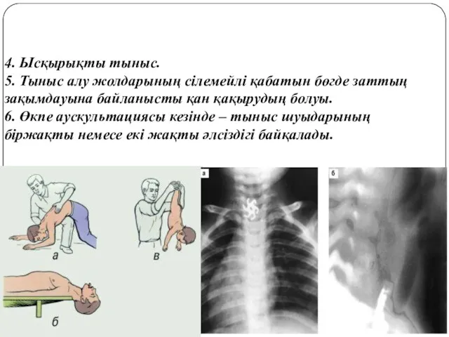 4. Ысқырықты тыныс. 5. Тыныс алу жолдарының сілемейлі қабатын бөгде