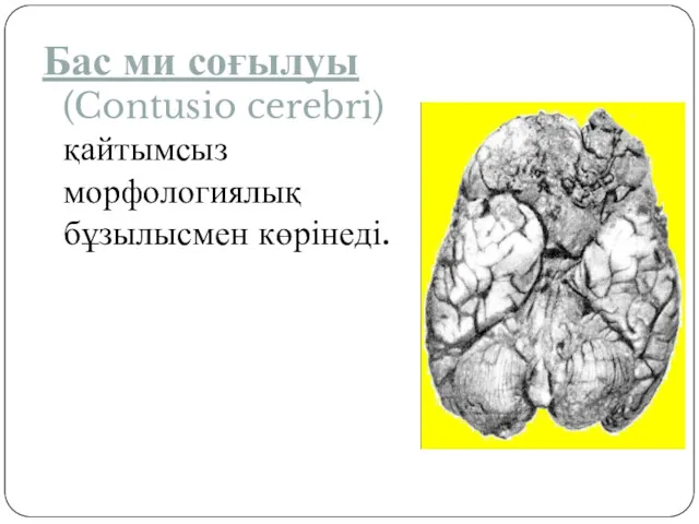 Бас ми соғылуы (Contusio cerebri) қайтымсыз морфологиялық бұзылысмен көрінеді.