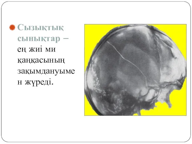 Сызықтық сынықтар – ең жиі ми қаңқасының зақымдануымен жүреді.