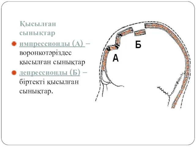 Қысылған сынықтар импрессионды (А) – воронкотәріздес қысылған сынықтар депрессионды (Б) – біртекті қысылған сынықтар.