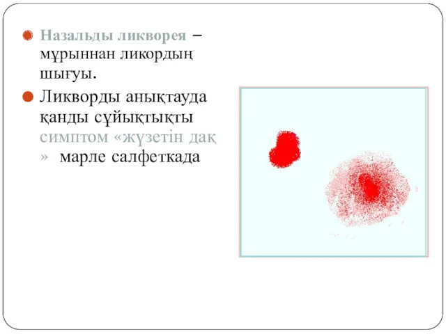 Назальды ликворея – мұрыннан ликордың шығуы. Ликворды анықтауда қанды сұйықтықты симптом «жүзетін дақ » марле салфеткада