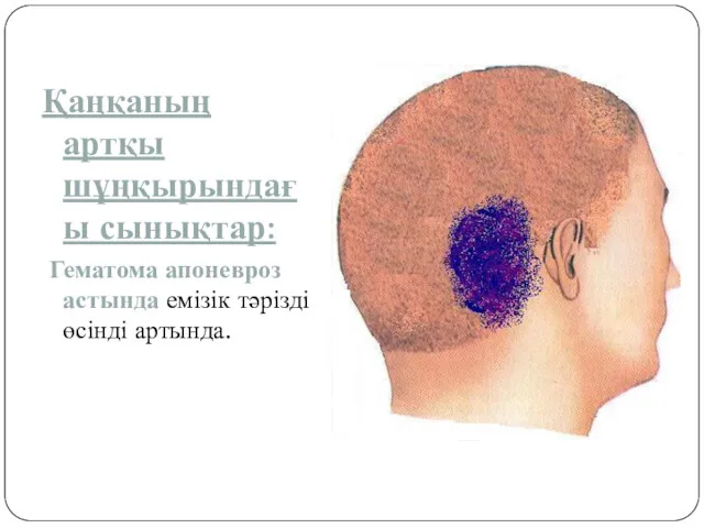 Қаңқаның артқы шұңқырындағы сынықтар: Гематома апоневроз астында емізік тәрізді өсінді артында.