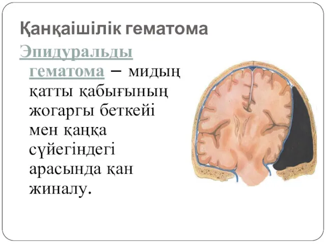 Эпидуральды гематома – мидың қатты қабығының жогаргы беткейі мен қаңқа сүйегіндегі арасында қан жиналу. Қанқаішілік гематома