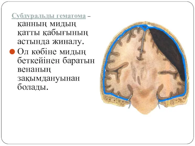 Субдуральды гематома – қанның мидың қатты қабығының астында жиналу. Ол