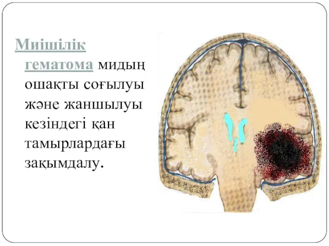 Миішілік гематома мидың ошақты соғылуы және жаншылуы кезіндегі қан тамырлардағы зақымдалу.