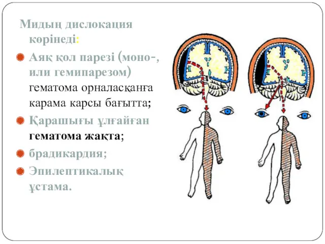 Мидың дислокация көрінеді: Аяқ қол парезі (моно-, или гемипарезом) гематома