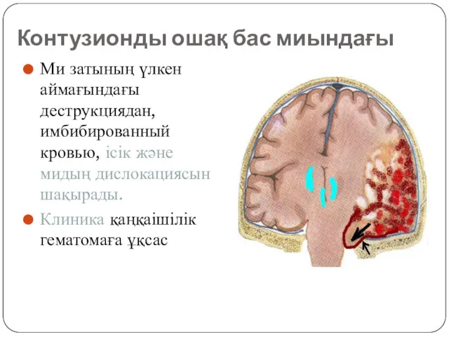 Контузионды ошақ бас миындағы Ми затының үлкен аймағындағы деструкциядан, имбибированный