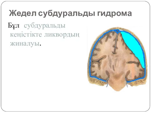 Жедел субдуральды гидрома Бұл субдуральды кеңістікте ликвордың жиналуы.