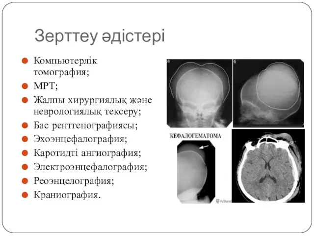 Зерттеу әдістері Компьютерлік томография; МРТ; Жалпы хирургиялық және неврологиялық тексеру;