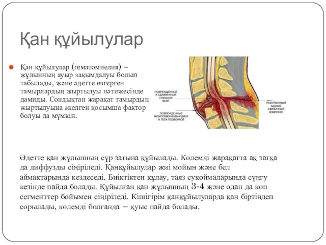 Қан құйылулар Қан құйылулар (гематомиелия) – жұлынның ауыр зақымдалуы болып