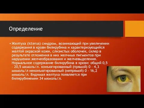 Определение Желтуха (icterus) синдром, возникающий при увеличении содержания в крови