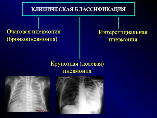 КЛИНИЧЕСКАЯ КЛАССИФИКАЦИЯ Очаговая пневмония (бронхопневмония) Крупозная (долевая) пневмония Интерстициальная пневмония