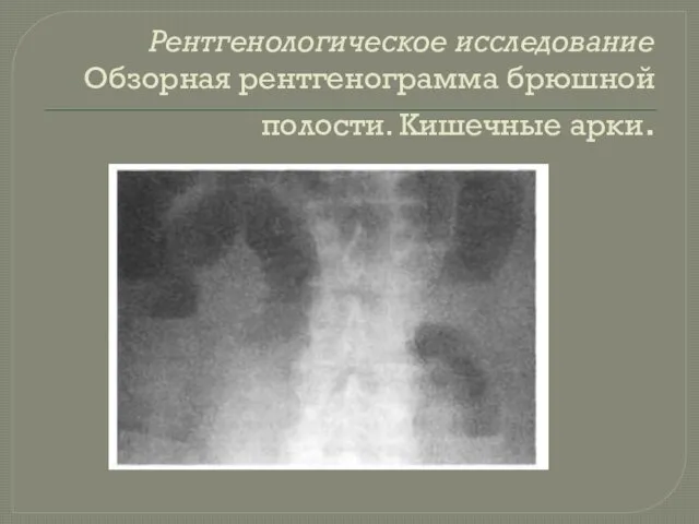 Рентгенологическое исследование Обзорная рентгенограмма брюшной полости. Кишечные арки.