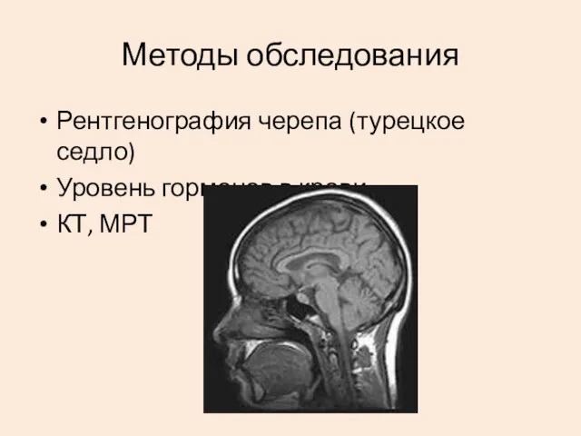 Методы обследования Рентгенография черепа (турецкое седло) Уровень гормонов в крови КТ, МРТ