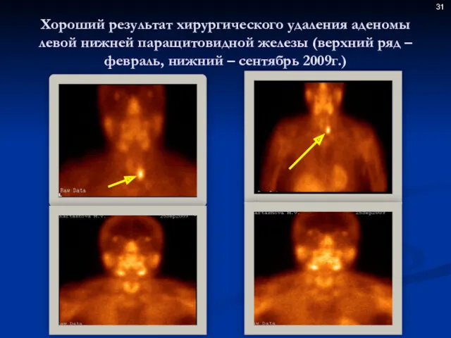 Хороший результат хирургического удаления аденомы левой нижней паращитовидной железы (верхний