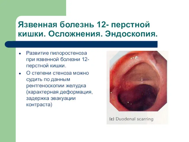 Язвенная болезнь 12- перстной кишки. Осложнения. Эндоскопия. Развитие пилоростеноза при