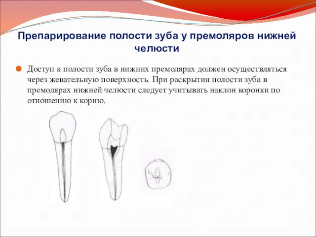Препарирование полости зуба у премоляров нижней челюсти Доступ к полости
