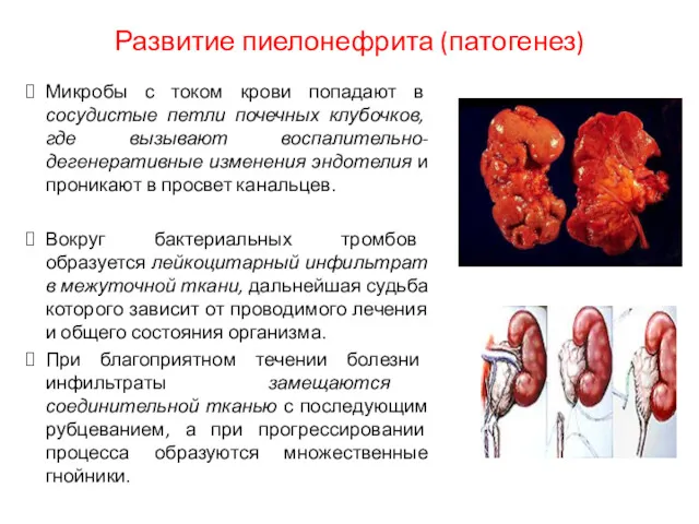 Развитие пиелонефрита (патогенез) Микробы с током крови попадают в сосудистые