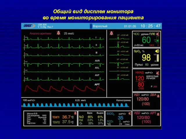 Общий вид дисплея монитора во время мониторирования пациента