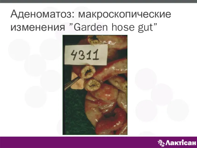 Аденоматоз: макроскопические изменения ”Garden hose gut”