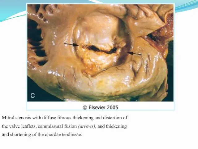 Mitral stenosis with diffuse fibrous thickening and distortion of the