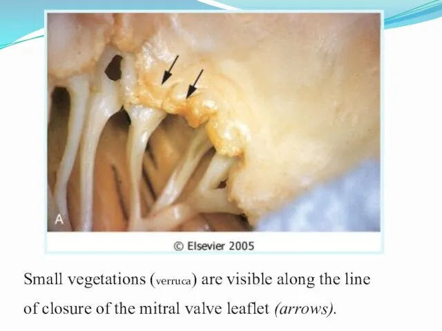 Small vegetations (verruca) are visible along the line of closure of the mitral valve leaflet (arrows).