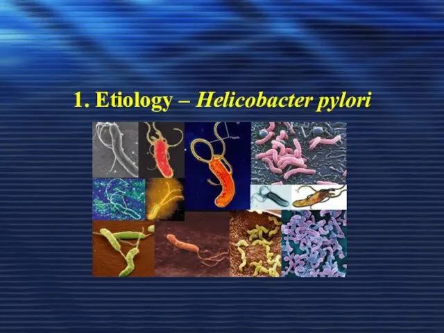 1. Etiology – Helicobacter pylori
