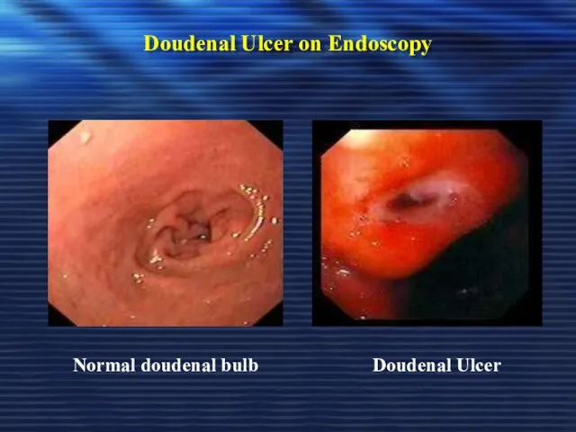 Doudenal Ulcer on Endoscopy Doudenal Ulcer Normal doudenal bulb