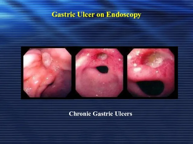 Gastric Ulcer on Endoscopy Chronic Gastric Ulcers