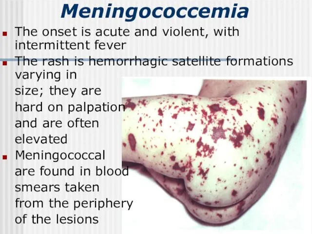 Meningococcemia The onset is acute and violent, with intermittent fever