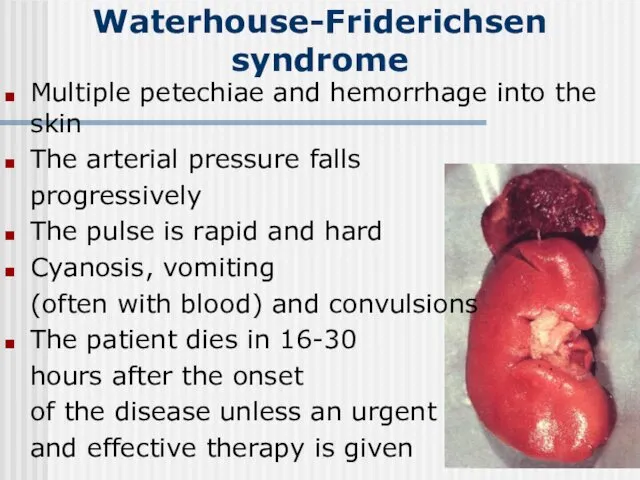 Waterhouse-Friderichsen syndrome Multiple petechiae and hemorrhage into the skin The