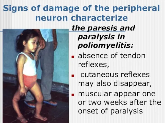 Signs of damage of the peripheral neuron characterize the paresis