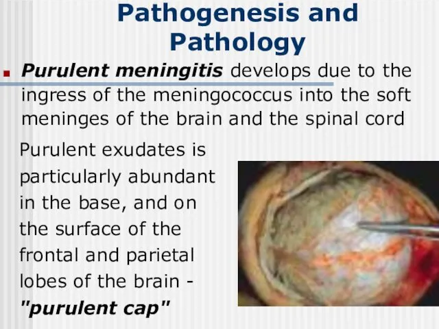 Purulent meningitis develops due to the ingress of the meningococcus