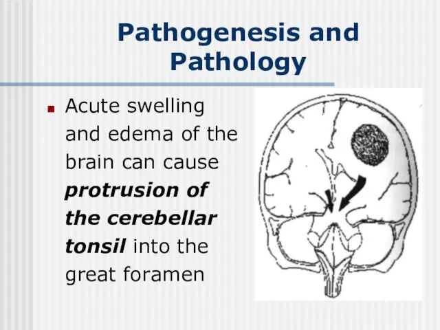 Acute swelling and edema of the brain can cause protrusion