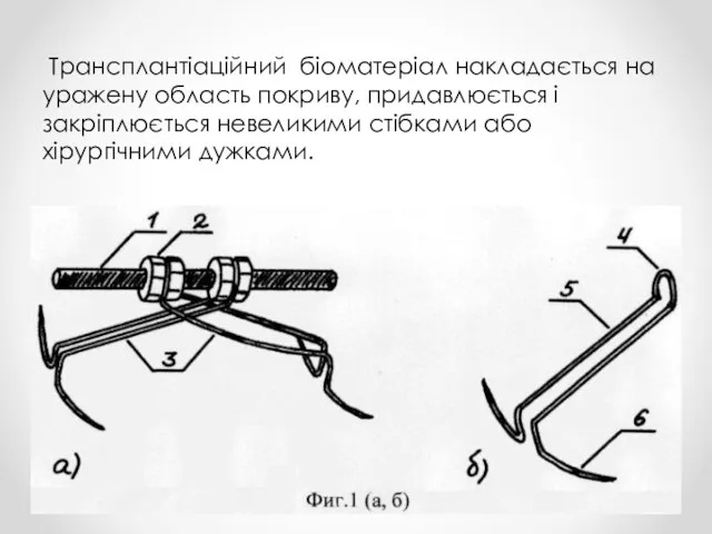 Трансплантіаційний біоматеріал накладається на уражену область покриву, придавлюється і закріплюється невеликими стібками або хірургічними дужками.