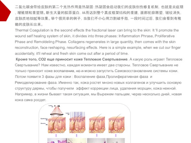 二氧化碳会带给皮肤的第二个光热作用是热凝固：热凝固会启动我们的皮肤创伤修复机制，也就是炎症期，增殖期和重塑期。新生大量的胶原蛋白，从而达到整个真皮框架结构的重建，面部轮廓雕塑，皱纹消失，皮肤质地细腻等效果。举个很简单的例子，当我们不小心用刀割破手指，一段时间过后，我们会看到有稚嫩的皮肤长出来。 Thermal Coagulation is the second effects the fractional laser