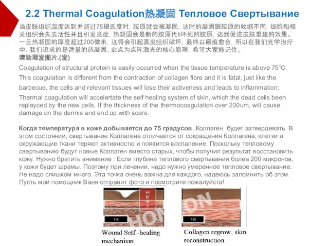 2.2 Thermal Coagulation热凝固 Тепловое Свертывание 当皮肤组织温度达到并超过75摄氏度时，胶原就会被凝固，这时的凝固跟胶原的收缩不同，细胞和相关组织会失去活性并且引发炎症，热凝固会是新的胶原代ti坏死的胶原，达到促进皮肤重建的效果。一旦热凝固的厚度超过200微米，这将会引起真皮组织破坏，最终以瘢痕愈合，所以在我们光学治疗中，我们追求的是适量的热凝固。此点为点阵激光的核心原理，希望大家能记住。 请助理发图片.(发) Coagulation of structural