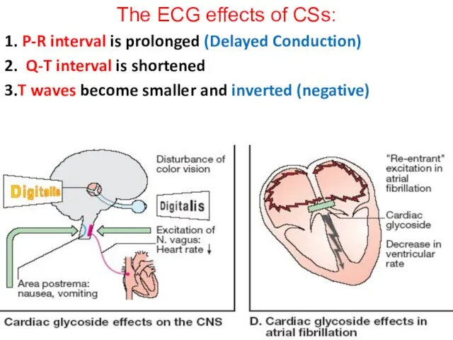 The ECG effects of CSs: 1. P-R interval is prolonged