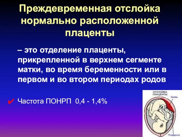 Преждевременная отслойка нормально расположенной плаценты – это отделение плаценты, прикрепленной