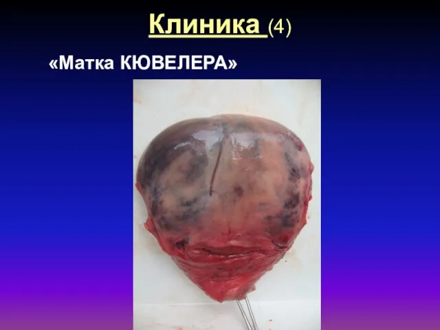 Клиника (4) «Матка КЮВЕЛЕРА»