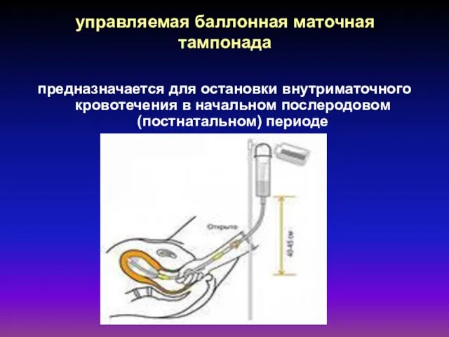 управляемая баллонная маточная тампонада предназначается для остановки внутриматочного кровотечения в начальном послеродовом (постнатальном) периоде