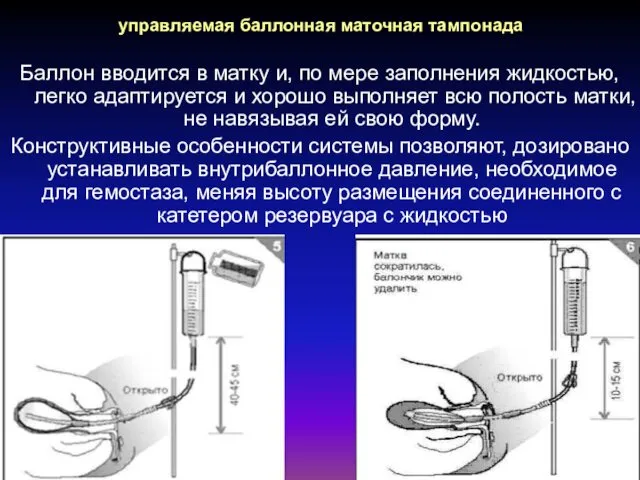 управляемая баллонная маточная тампонада Баллон вводится в матку и, по