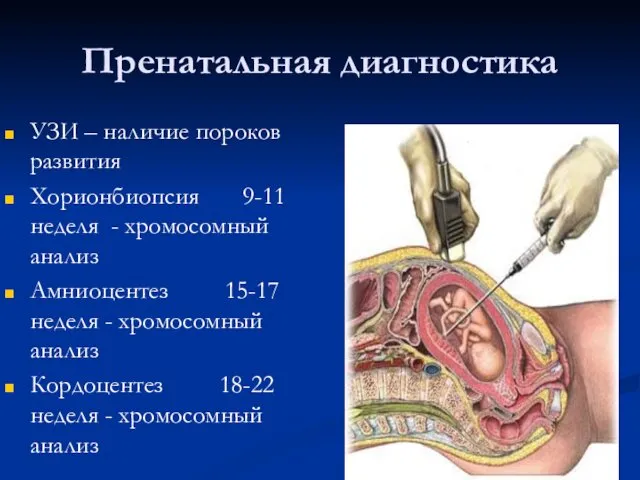 Пренатальная диагностика УЗИ – наличие пороков развития Хорионбиопсия 9-11 неделя